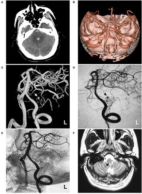 Case Report: Can Ruptured Aneurysms in the Hypoplastic and Plexiform Posterior Inferior Cerebellar Arteries Be Safely Occluded?